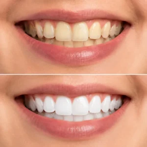 Teeth before and after professional whitening