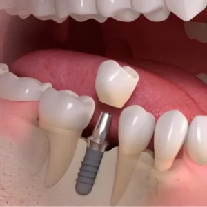 Illustration of a dental implant replacing a missing tooth