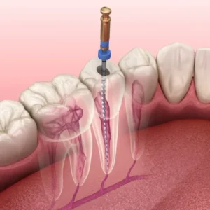 Illustration of root canal treatment inside a tooth