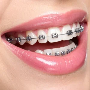Smile with metal braces