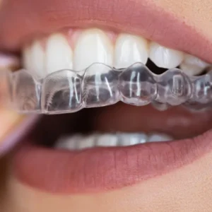 Clear aligner on a patient's teeth