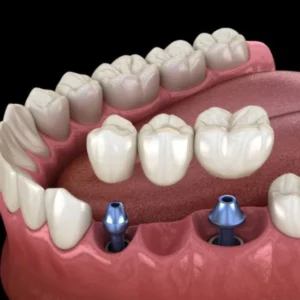 Illustration of a dental bridge supported by two implants