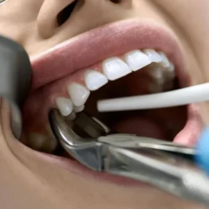 Tooth extraction with dental forceps